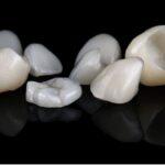 Tooth Restoration Case Study