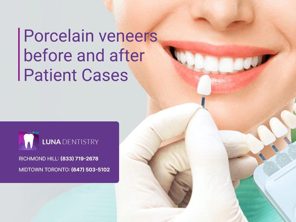 Porcelain-veneers-before-and-after-Patient-Cases