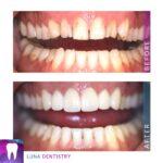 restored 6 upper teeth